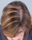 After Hair Transplant&nbsp;Hair Thinning